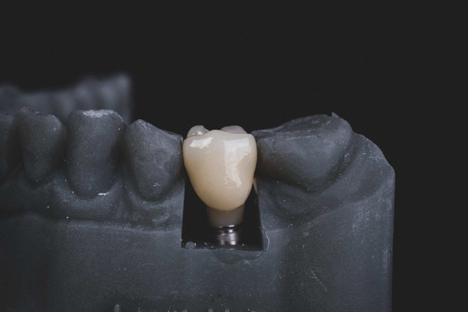 Можно ли ставить имплант при полном отсутствии зубов?