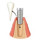 На место удаленного зуба сразу устанавливают имплант