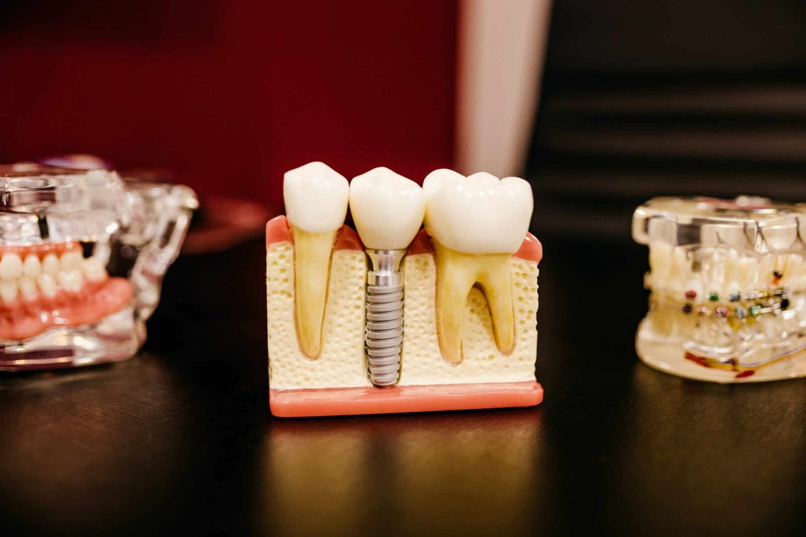 Имплантация зубов: плюсы и минусы